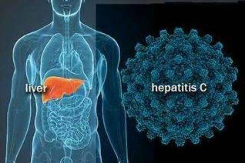 目前,中国约有1000万丙肝病毒感染者,并呈稳步增长的趋势,多数丙肝