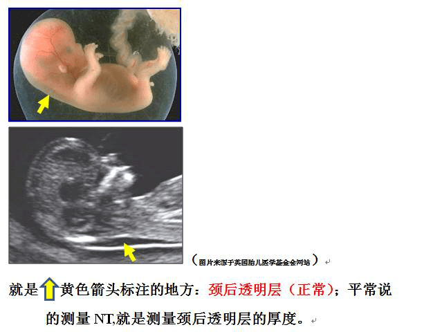 胎儿nt检查的方法时间和要求读完这篇你都懂了