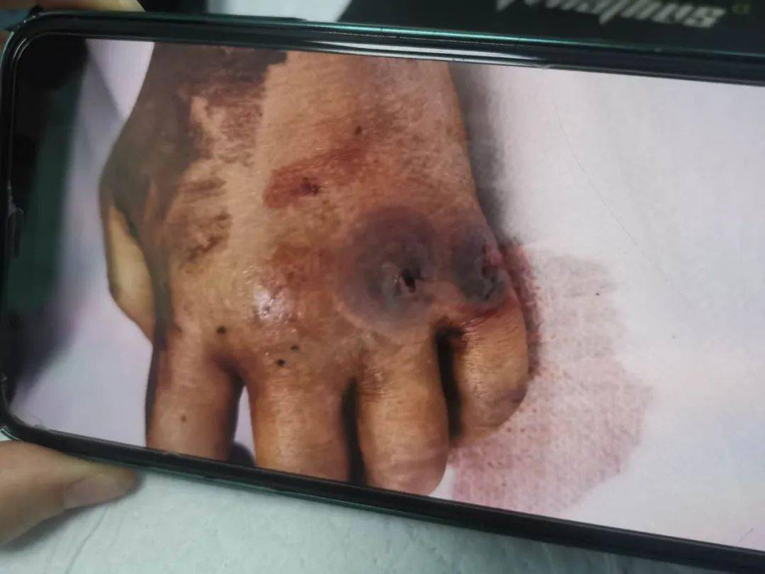 已有7岁男孩被蛇咬到手,生命垂危!_毒蛇