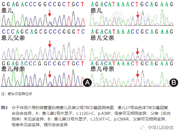 【病例报告】tbcd基因复合杂合变异致分子伴侣介导的微管蛋白病一例
