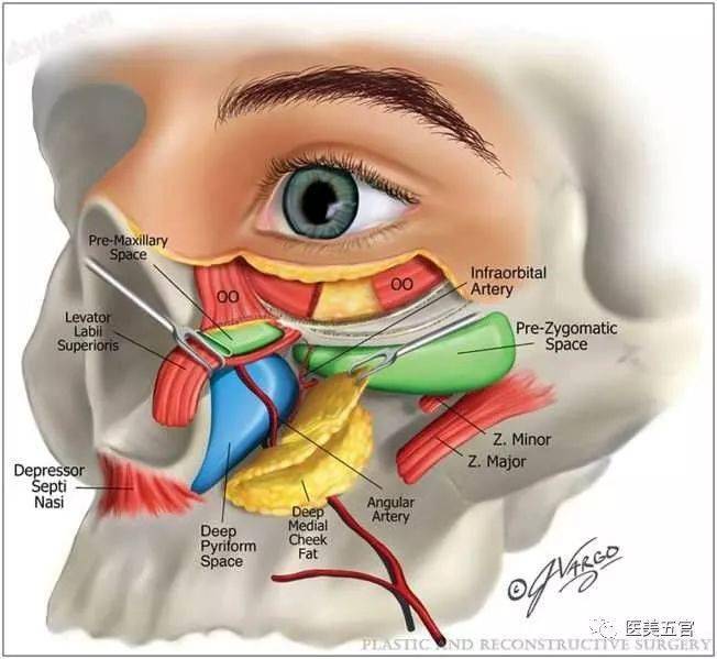 pzs,如图20所示,是颧骨体上方的一个三角形空间,由眼轮匝肌保留韧带和