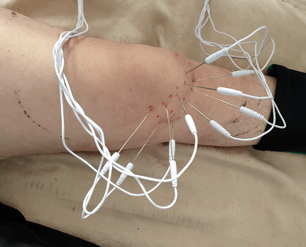 【特色诊疗】头痛十余年 内热针显效