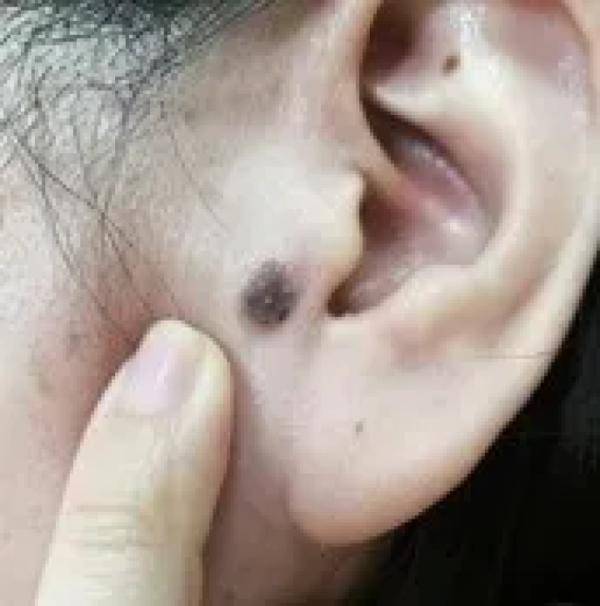 黑痣癌变从发病到去世不到两个月身上有这种痣要小心了