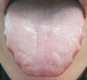 舌头胖大(舌边有齿痕),舌苔厚:舌质颜色淡,整体比较胖嫩,舌边能看到