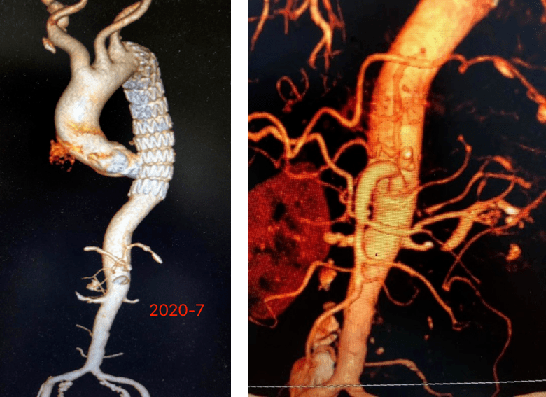 经典病例 | 顽固性高血压病史30余年,肾动脉支架植入术有效缓解_手机