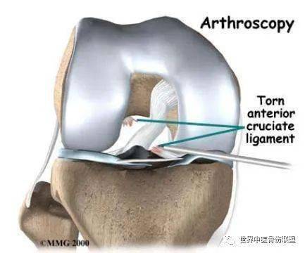 十字韧带损伤
