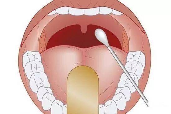 扁桃體炎對人體的潛在危害