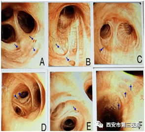 【医者解读】遇见气管憩室莫惊慌