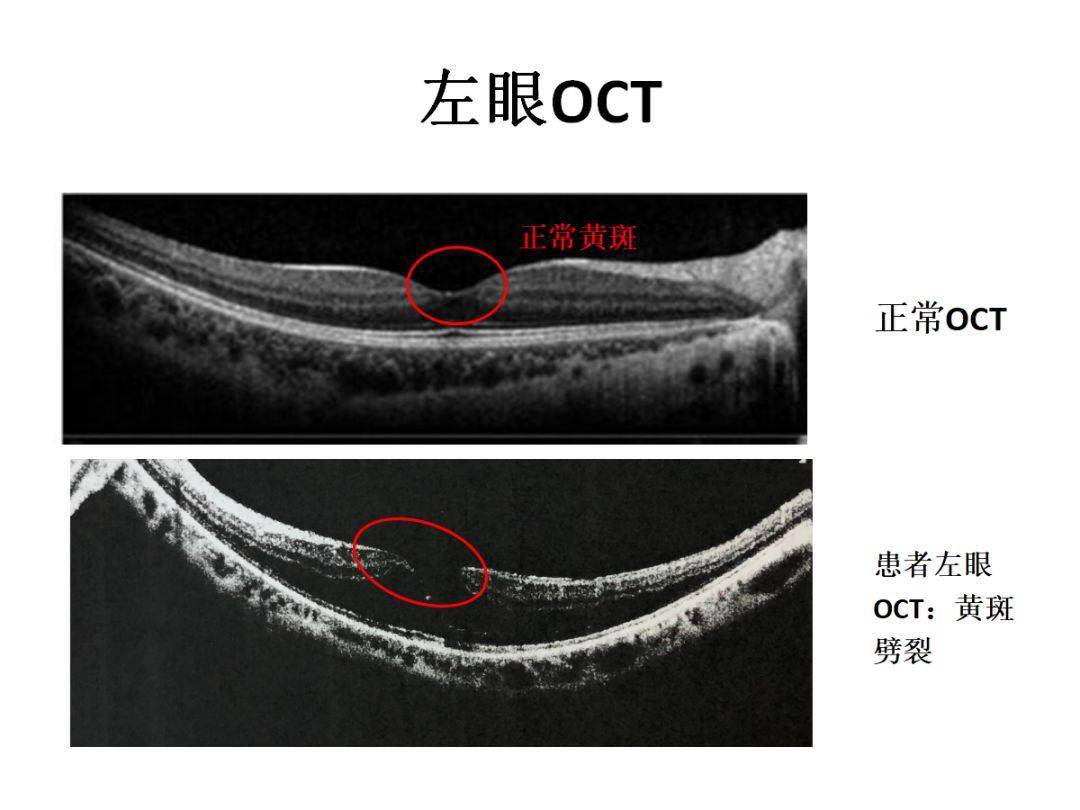 術前左眼黃斑劈裂,術後1年時,視網膜基本貼附,眼軸較術前縮短了1.