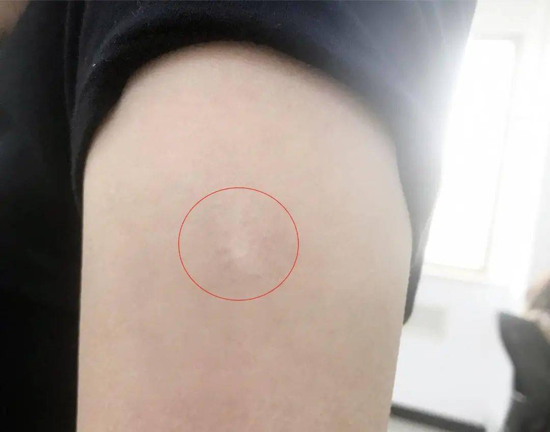 95后的"迷你"卡疤当然除了外界因素,卡疤的大小,凹