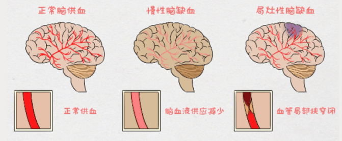患者常常感觉头重,头晕,头痛,去医院做影像学检查除了有动脉硬化或脑