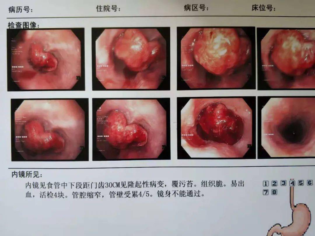 卜建石教授表示,食管癌比其他的肿瘤更难被早期发现,一旦出现症状,大