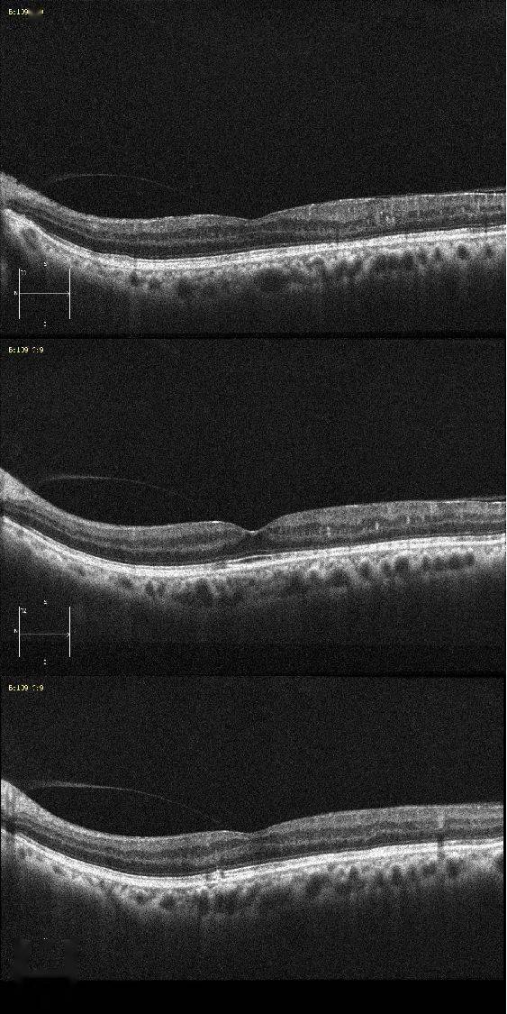 鼻颞侧略有增厚,视网膜层间点状高信号,椭圆体带连续性较差,未见明显
