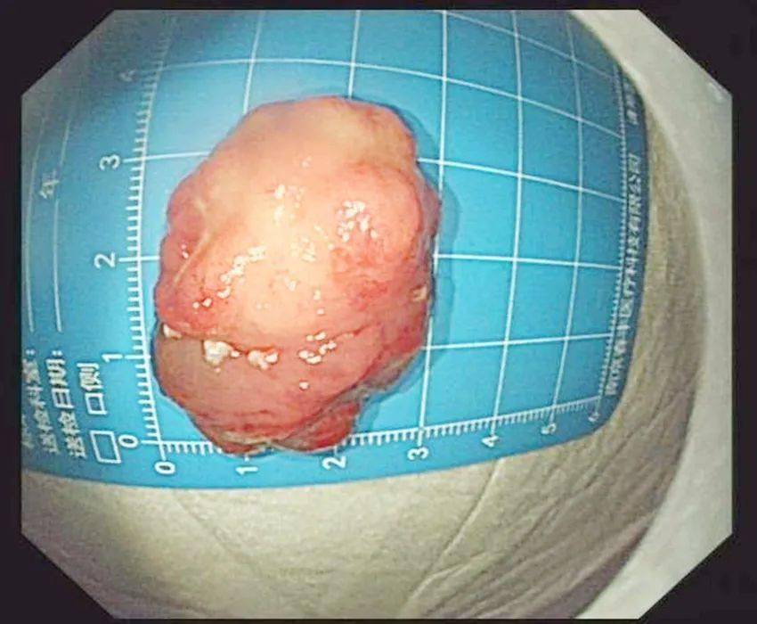 胃镜室采用粘膜下剥离术(esd) 成功切除一例胃窦大息肉
