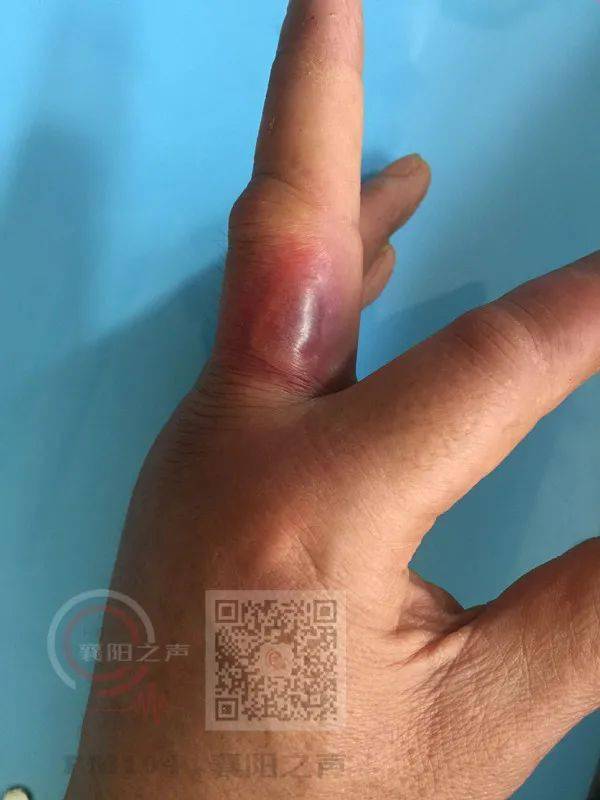 襄阳男子与小龙虾握了个手出大事了