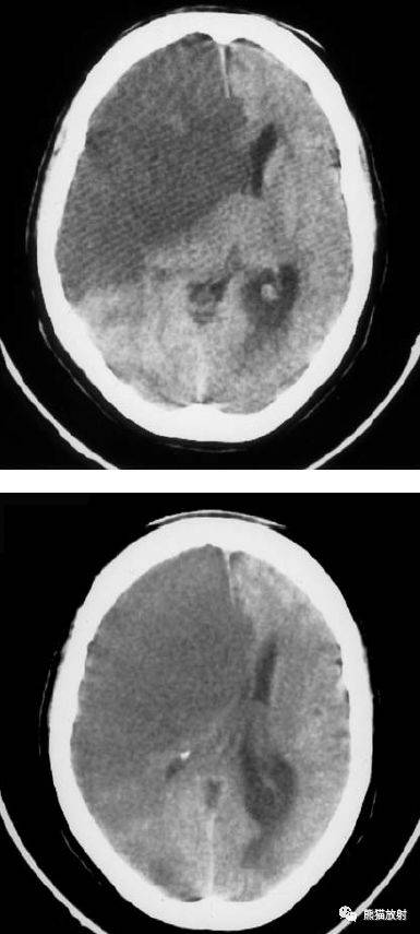 脑梗死丨演变血供区域分布ct表现