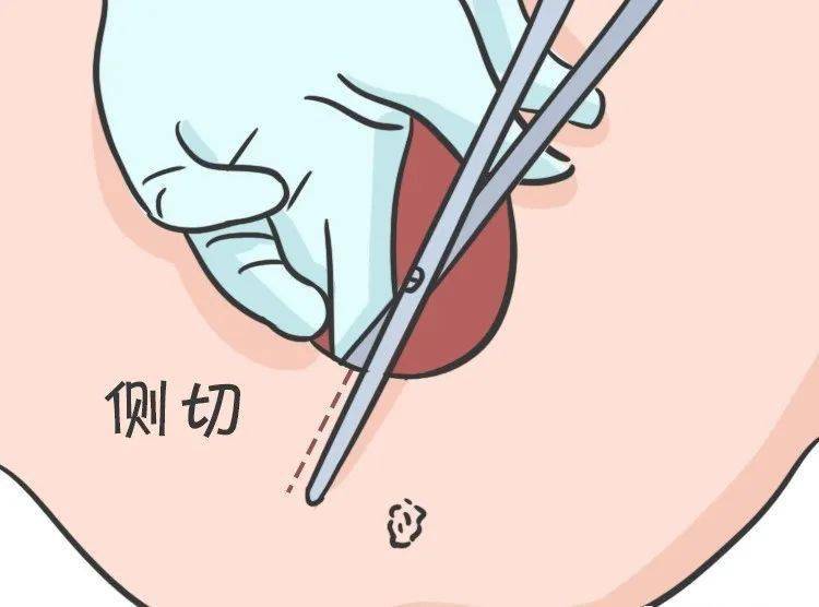 部分阴道分娩的女性在分娩时经历了侧切这一刀,会阴侧切能够减少会阴