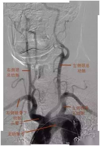 解剖颅内血管超详脑供血系统分类