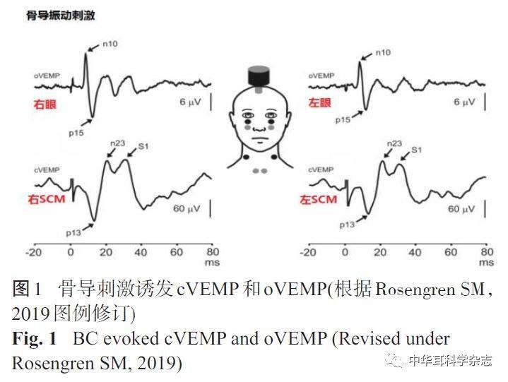 前庭诱发的肌源电位临床应用现状