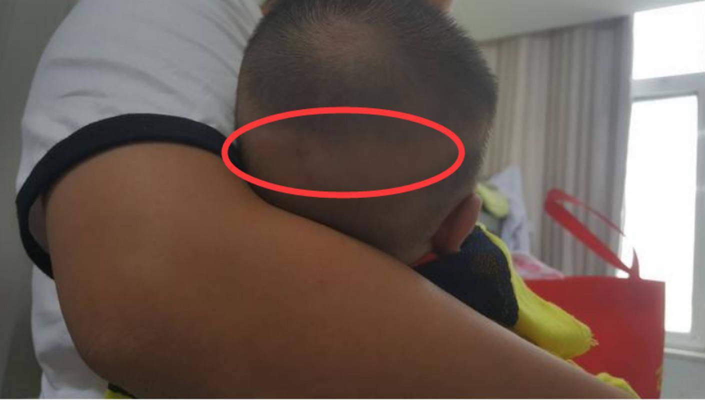 三个月婴儿枕秃图片图片