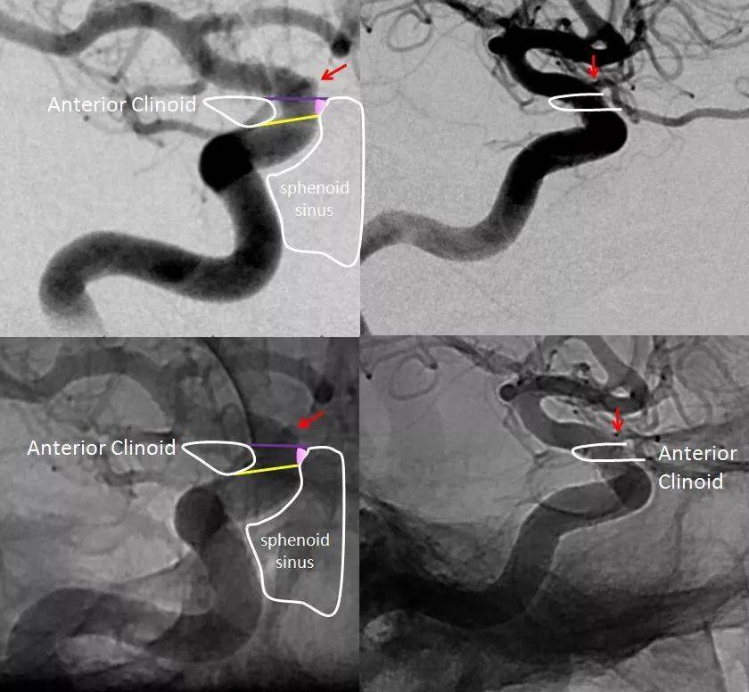 【推荐】颈内动脉走形图谱(2):岩段和破裂孔段