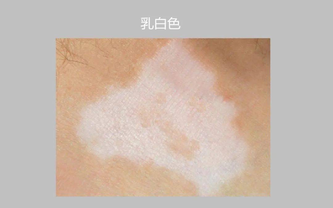 颜色辨别乳白色02药物治疗 饮食调理,此时病情处于初期,治疗难度较低