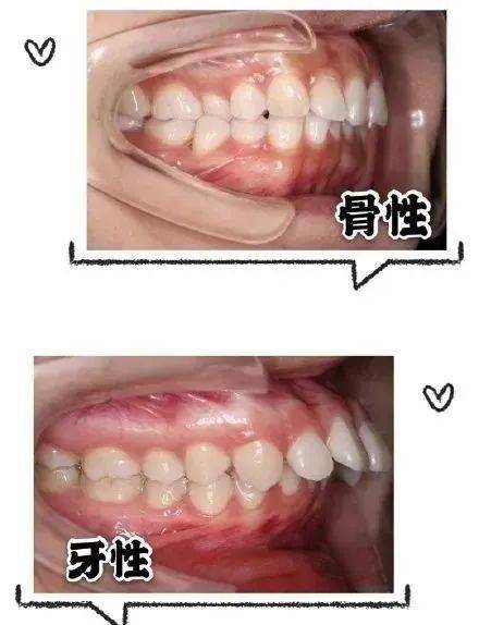 三招教你辨别骨性和牙性龅牙