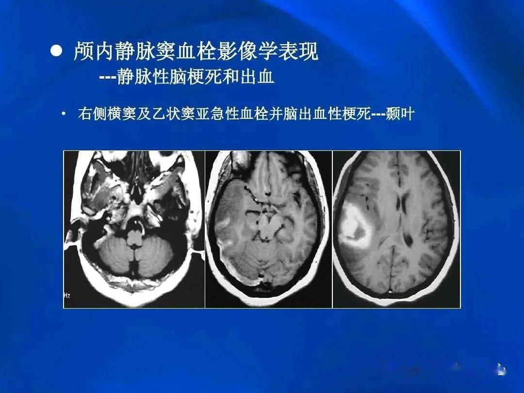 颅内静脉窦血栓形成的影像学表现