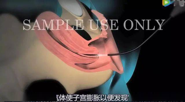 宫腔镜检查,你了解吗?_子宫