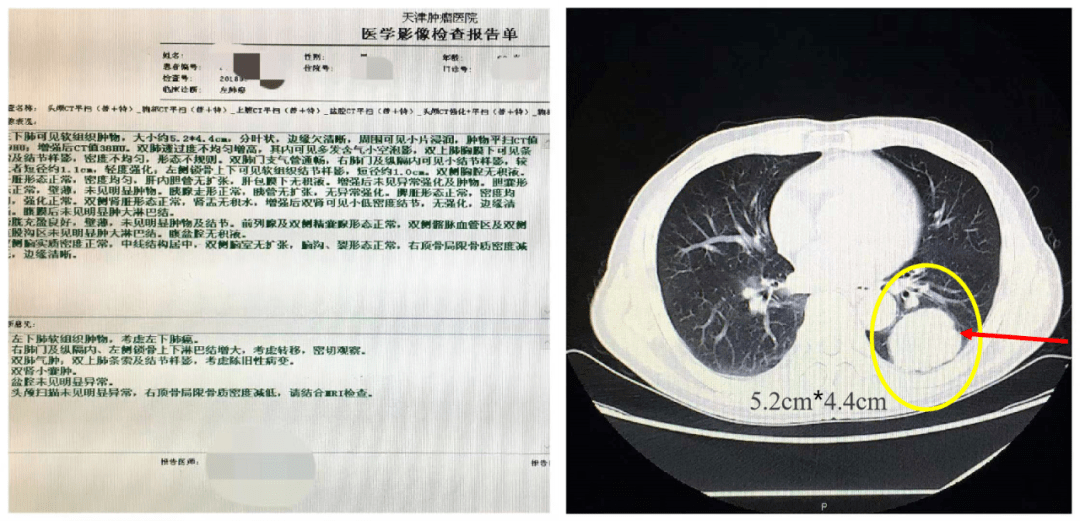 圖1 基線情況診斷左下肺癌,左側鎖骨上下淋巴結轉移,骨轉移.