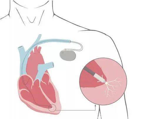 使之激动和收缩,即模拟正常心脏的冲动形式和传导,以治疗由于某些心律