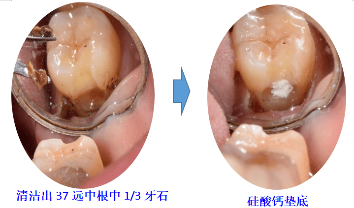 面對這種磨牙遠中齦下齲洞引起的牙髓炎或者根尖炎,在做根管治療之前