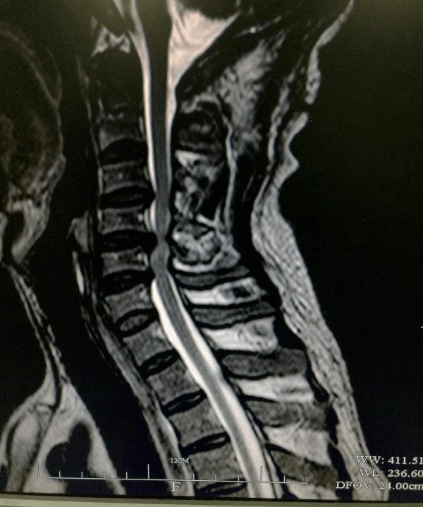 頭暈待查一例脊髓型頸椎病的全科診療體會文獻薈萃