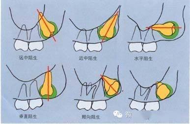 口腔麻醉拔牙术阻生牙拔除