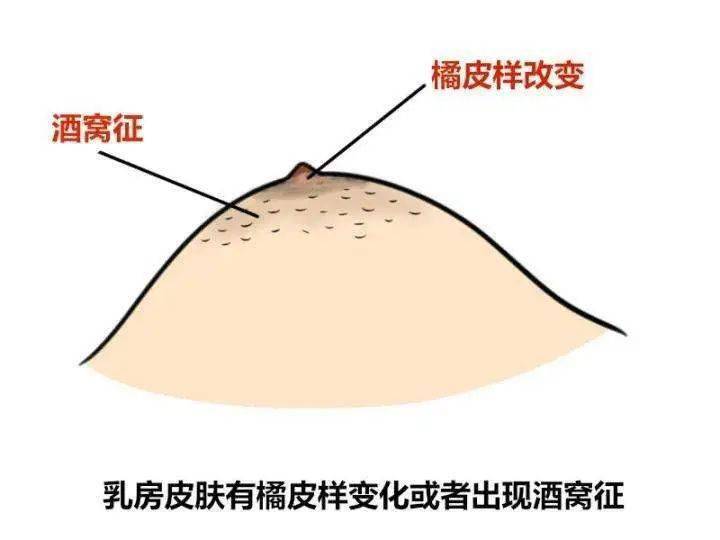 乳腺增生酒窝症状图图片