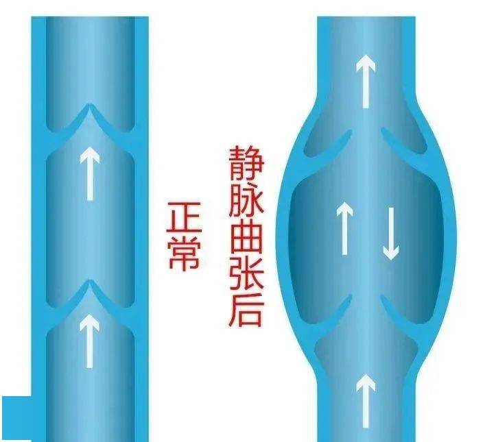 久坐久站当心腿上长"蚯蚓",不要等烂腿了再治!_静脉