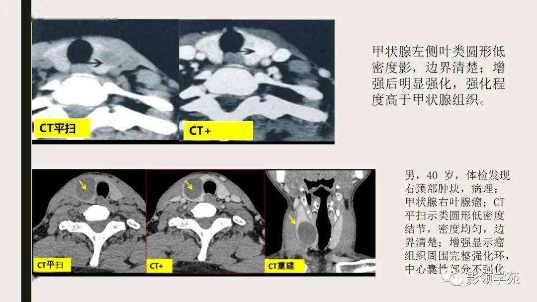 甲状腺CT图解图片
