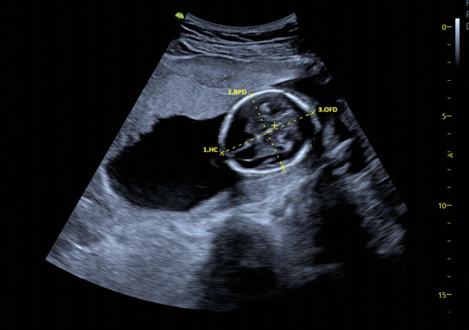 实现全方位多角度观察胎儿;自动测量胎儿颈项透明层,胎儿双顶径,腹围