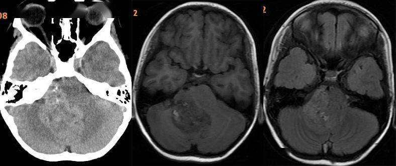 儿童后颅窝占位你想知道的全在这里