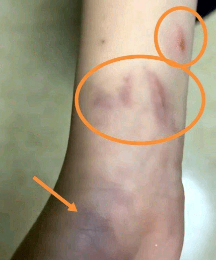 揭阳一小学生被老师打手,致手部淤血!家长反应情况却被移出群聊!