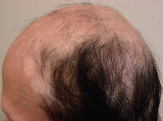 一文看懂斑秃的复杂面孔