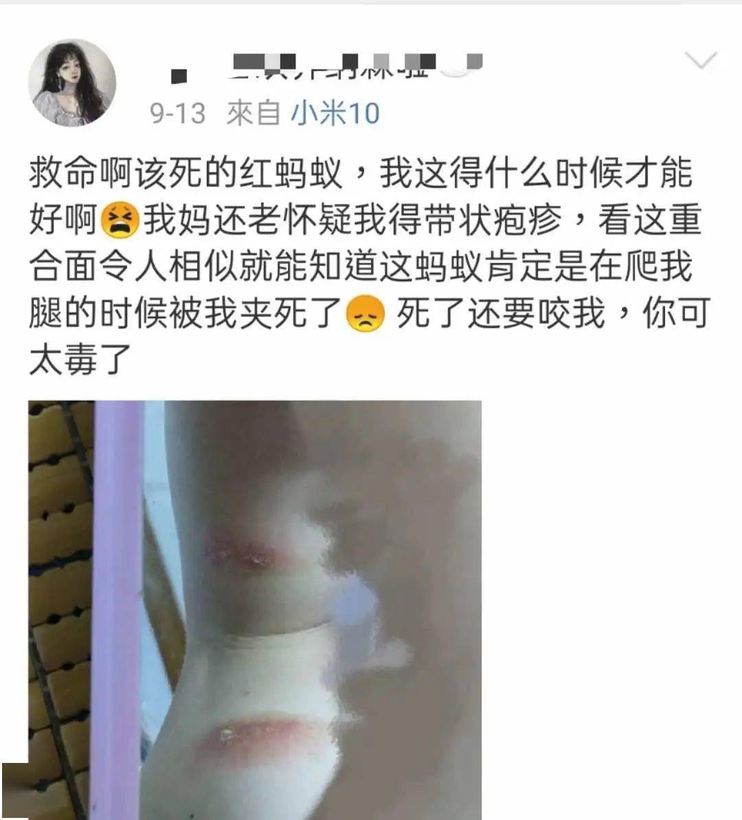 被蚂蚁咬了起脓包图片图片