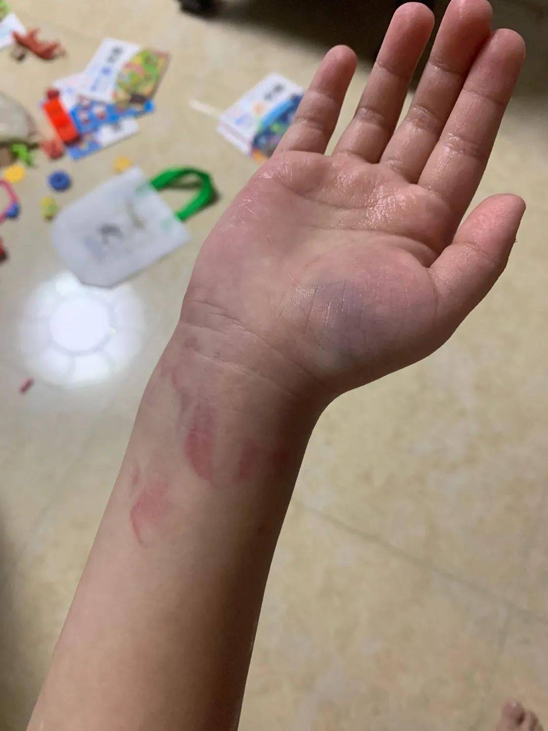 从视频可见,孩子手上多处淤青发紫,看着让人心疼.