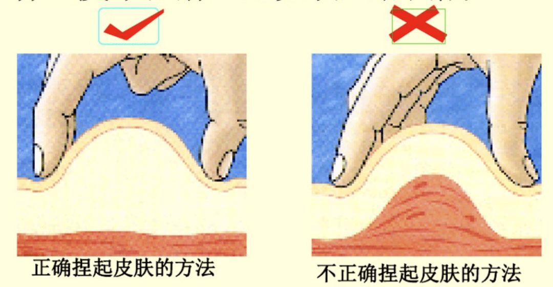 皮下针注射漫画示意图图片