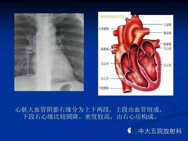 胸部正位片验证picc