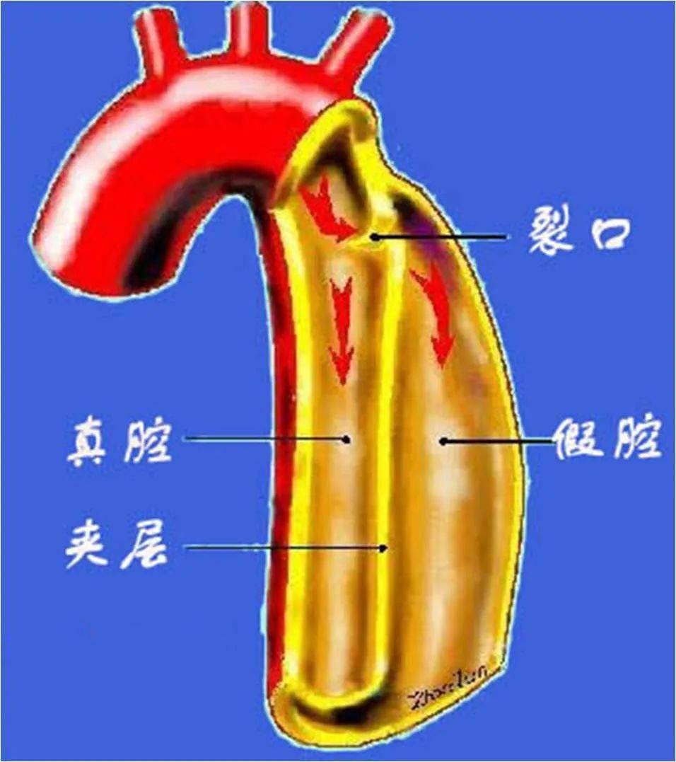 秋冬季高发……_主动脉