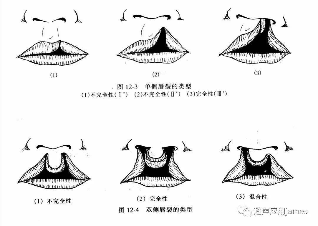 轻松掌握胎儿唇腭裂的超声诊断