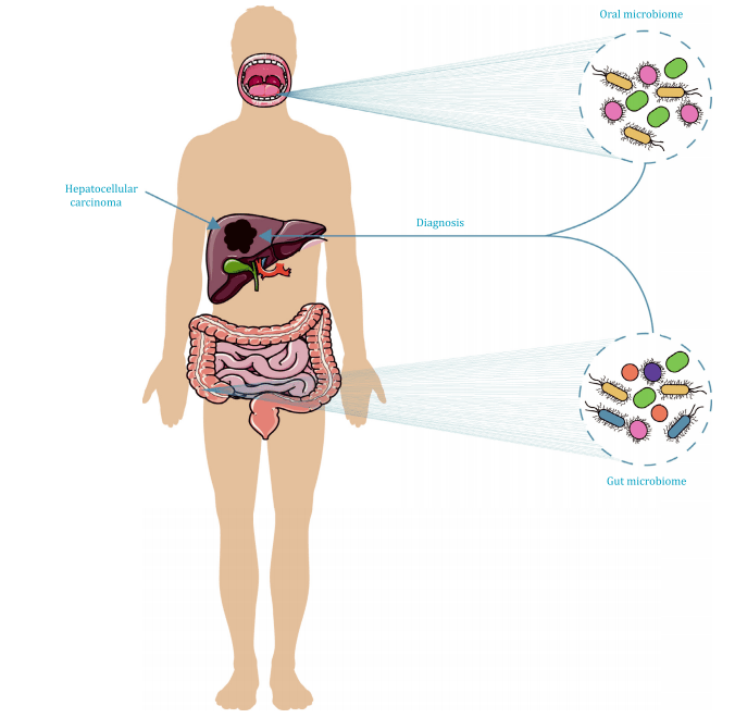 hbpd int丨人体微生物组是肝细胞肝癌的诊断生物标志物
