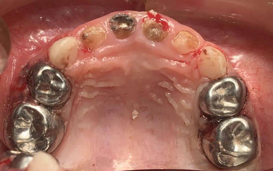一个坏习惯3岁宝宝烂12颗牙口腔专家全麻治疗除病痛