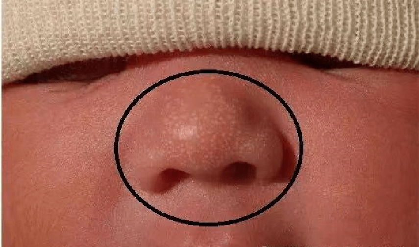 超全3分钟教你带图快速识别宝宝急疹痤疮麻疹等皮肤问题